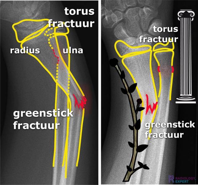 radius greenstickfractuur en een torus fractuur van de ulna