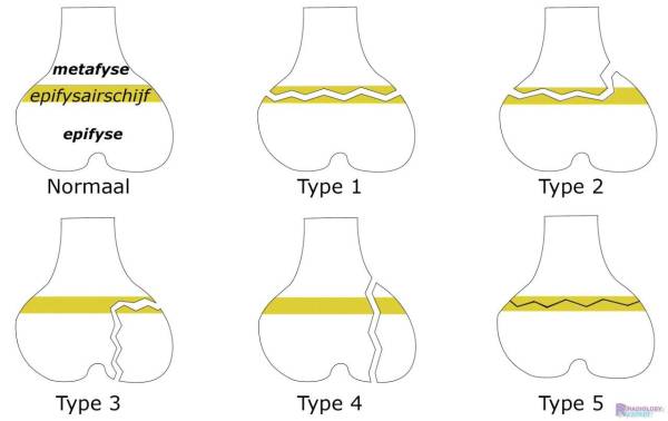 Epifysiolyse volgens de Salter & Harris classificatie