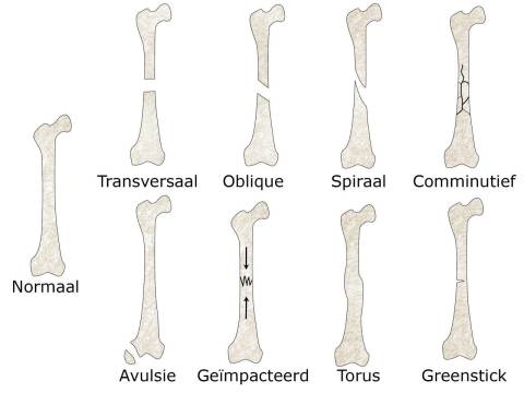 Verschillende soorten fracturen.