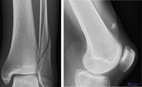 Spiraalfractuur en avulsiefractuur quadricepspees