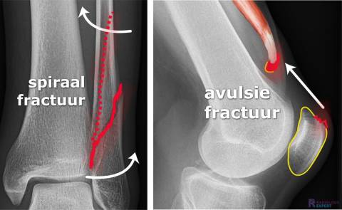 Spiraalfractuur en avulsiefractuur quadricepspees
