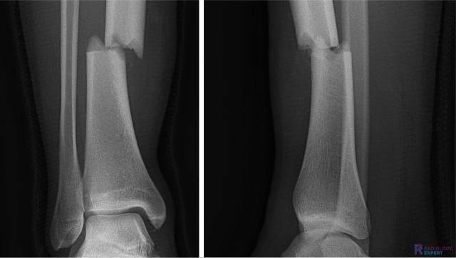 Beschrijving fractuur dislocatie