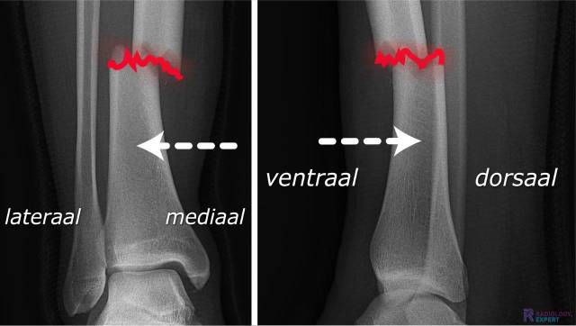 Beschrijving fractuur dislocatie