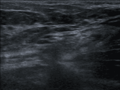 Ultrasound; inguinal hernia