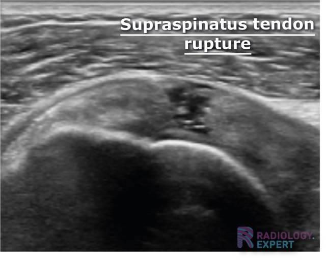 A supraspinatus tendon rupture on an ultrasound examination