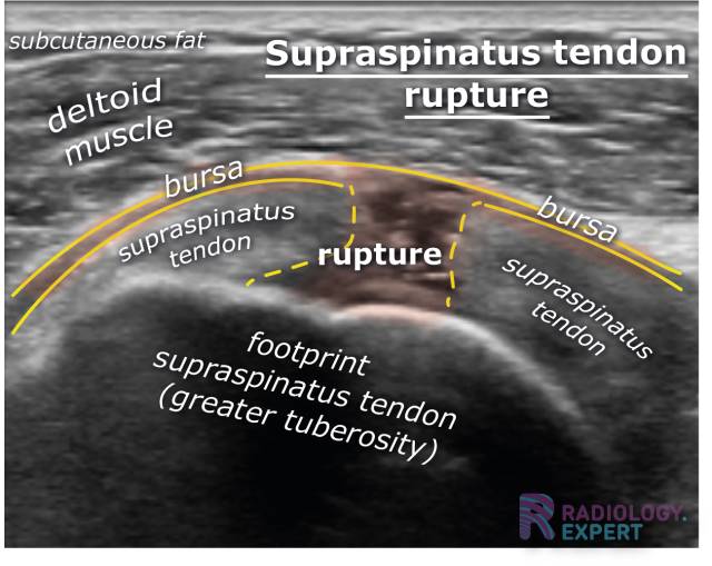 A supraspinatus tendon rupture on an ultrasound examination