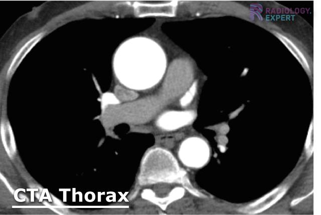 CT angiography (CTA) of the thorax. 
