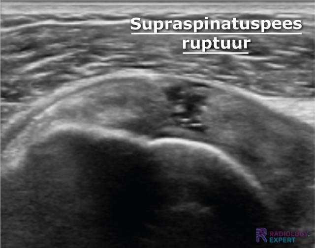 Supraspinatuspees ruptuur op een echo onderzoek