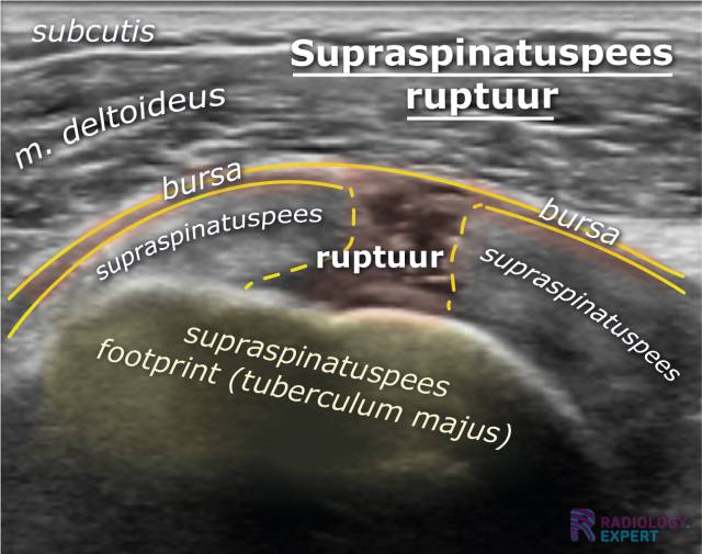 Supraspinatuspees ruptuur op een echo onderzoek