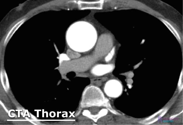  CT angiografie (CTA) van de thorax.