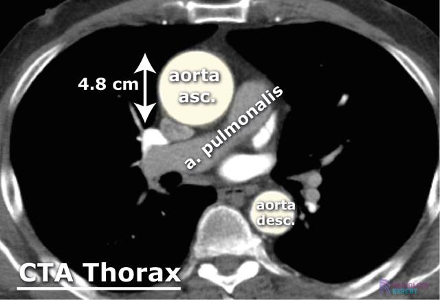  CT angiografie (CTA) van de thorax.