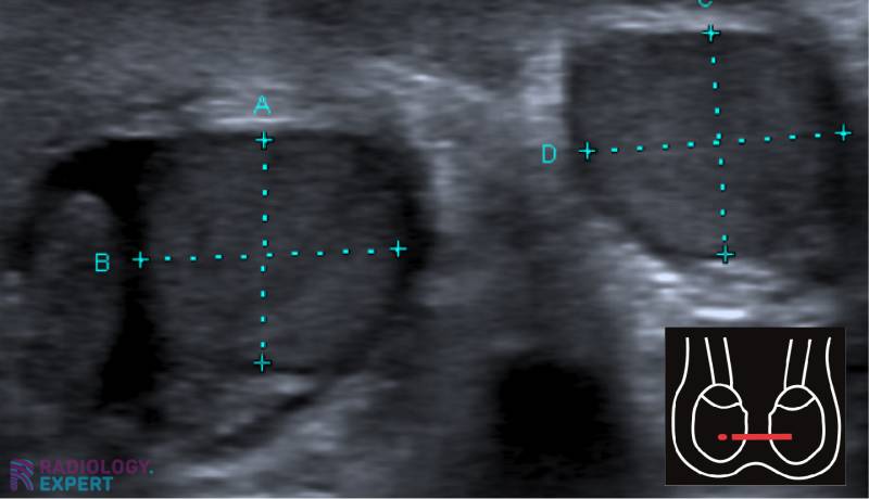 Scrotal ultrasound