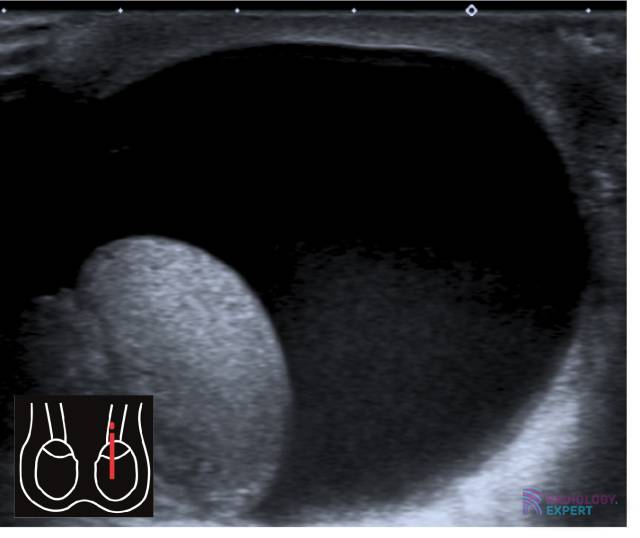 Echo scrotum; hydrocèle.