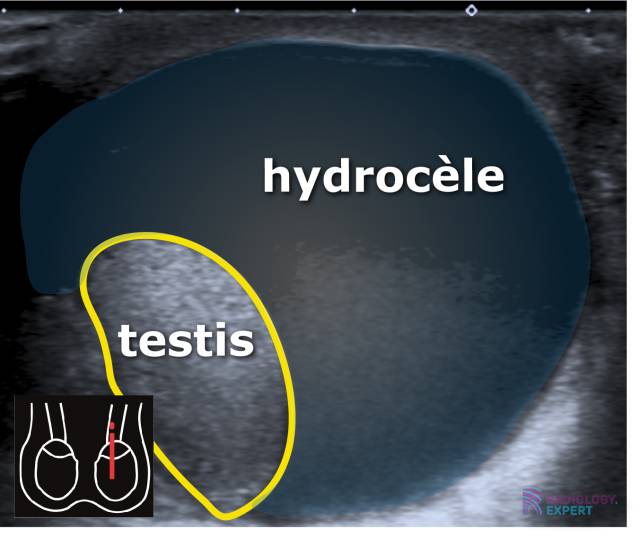 Echo scrotum; hydrocèle.