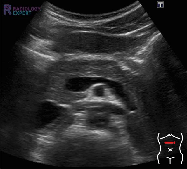 send Inferior loss Abdominal ultrasound