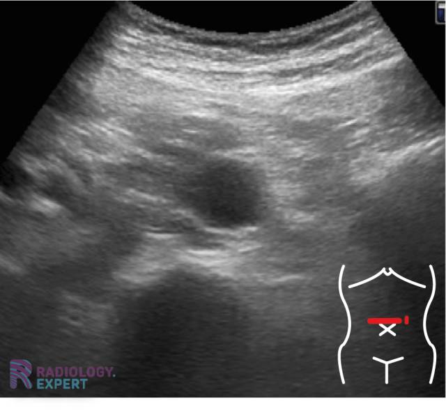 Abdominal ultrasound
