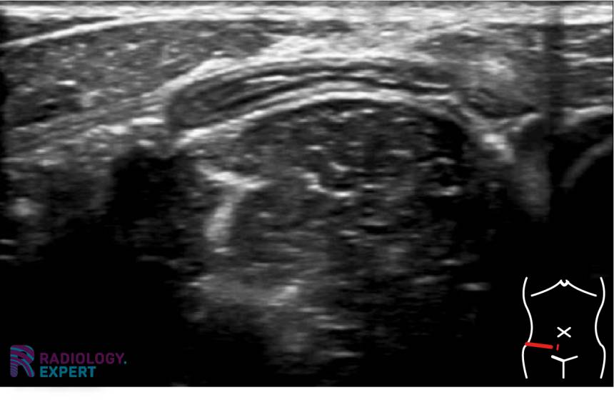 Abdominal ultrasound