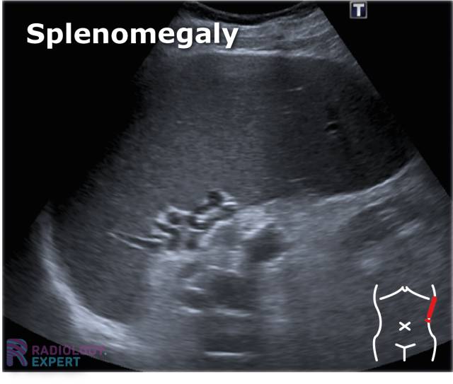 Spleen Anatomy Ultrasound