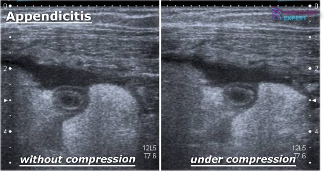 Ruptured Appendix Ultrasound