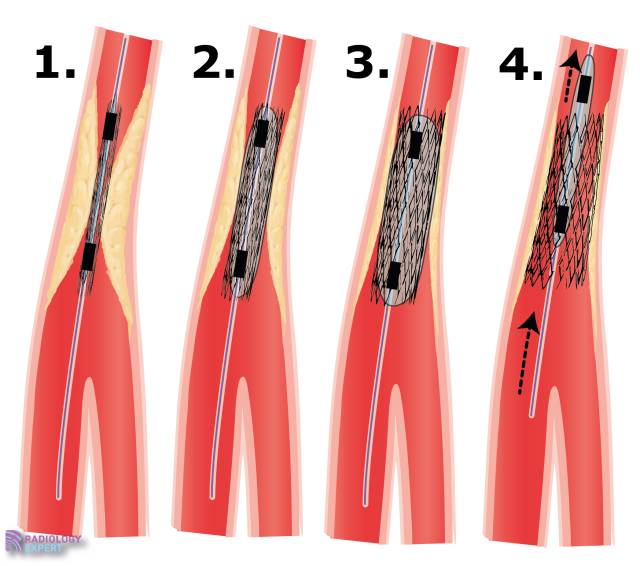 Vasculaire Interventie