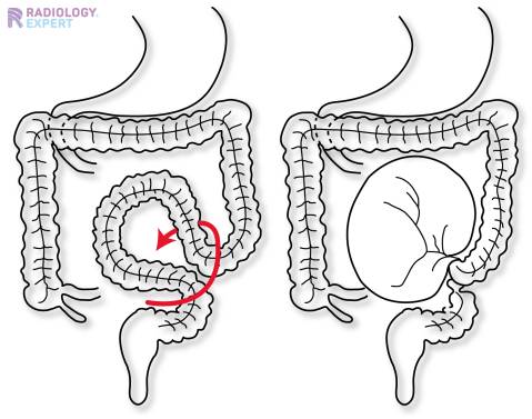 Abdominal X-ray