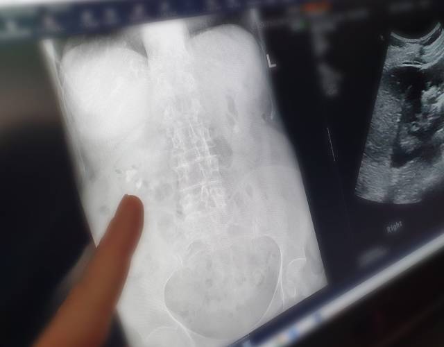 Abdominal X-ray