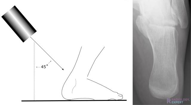 Postoperative lateral radiograph of the calcaneus shows anatomical... |  Download Scientific Diagram
