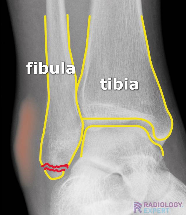 Weber A fracture