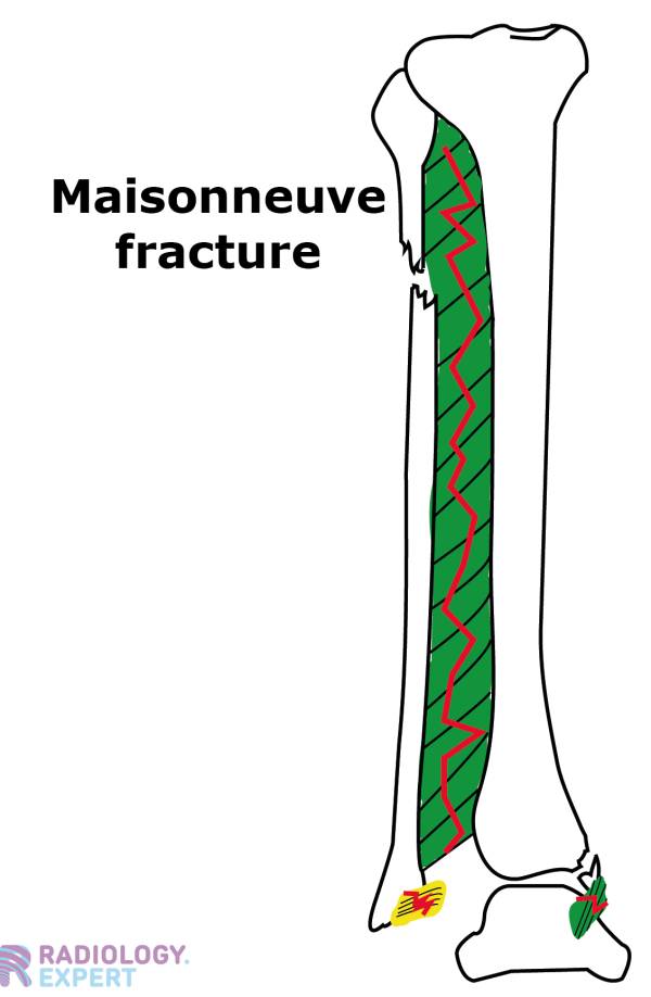 XAnkle