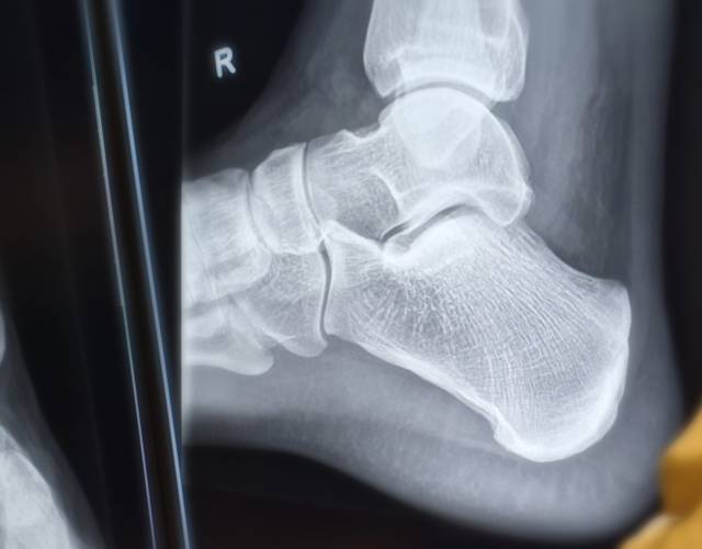 Periarticular opening wedge osteotomy for severe valgus deformity and  associated rearfoot tarsal coalitions