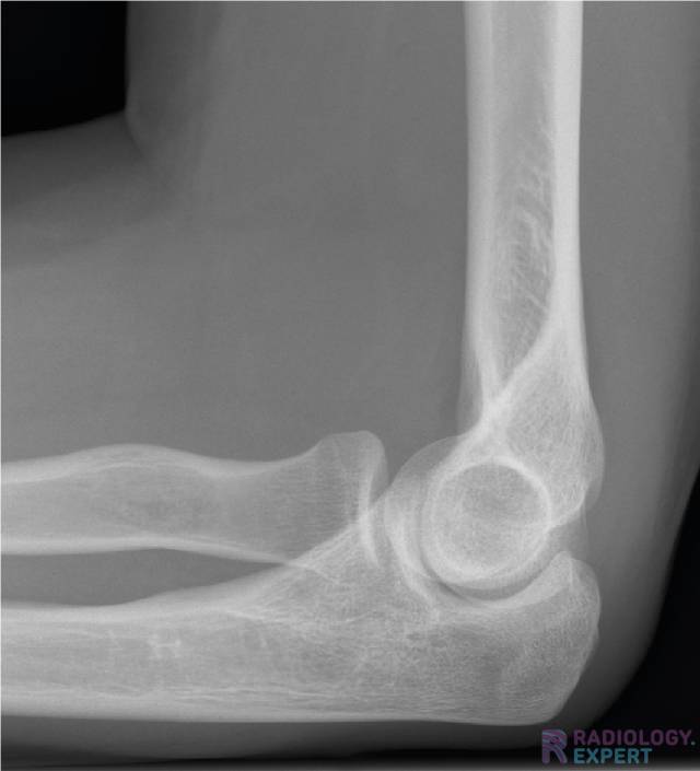 Normale anatomie op een  X-elleboog opname (laterale opname)