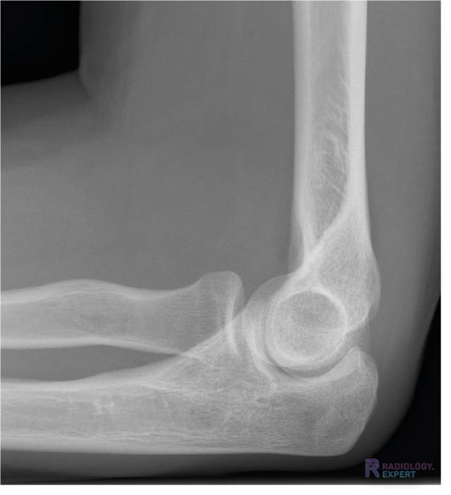 Normale anatomie op een  X-elleboog opname (laterale opname)