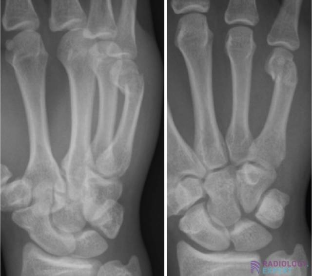 Boxer’s fracture.