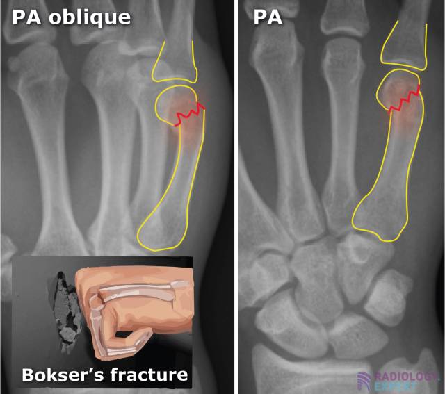 Boxer’s fracture.