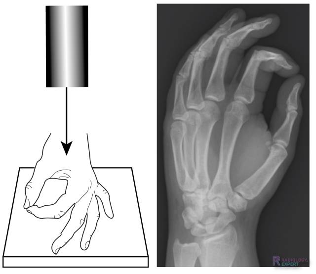 Hand Röntgenfoto Clipart