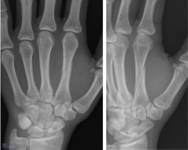 Metacarpaal fractuur