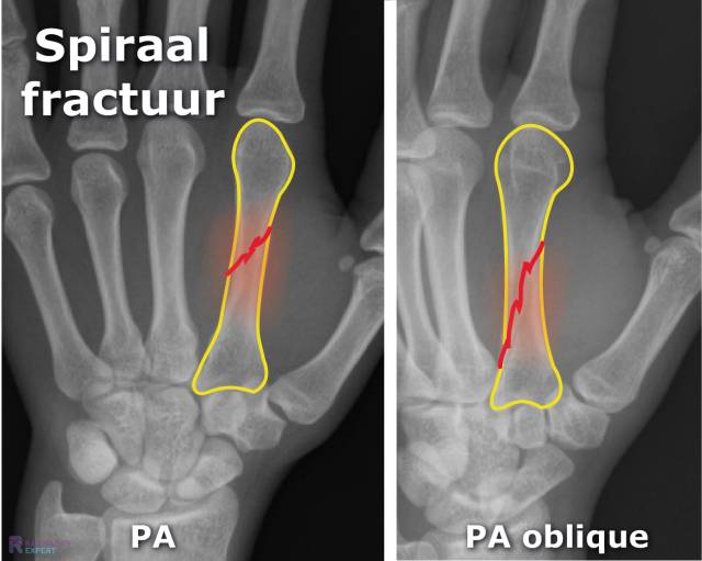 Metacarpaal fractuur