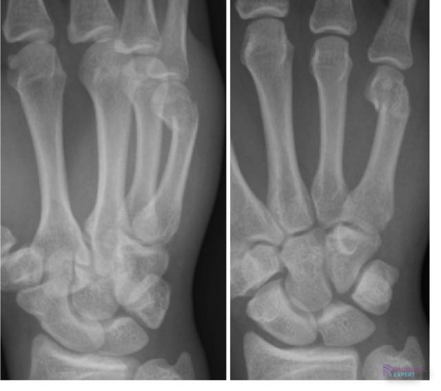 Subcapitaal fractuur MC-V (= boksersfractuur).