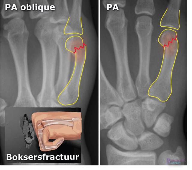 Subcapitaal fractuur MC-V (= boksersfractuur).