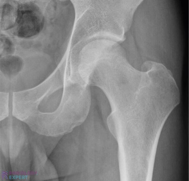 Normal anatomy AP image of the hip