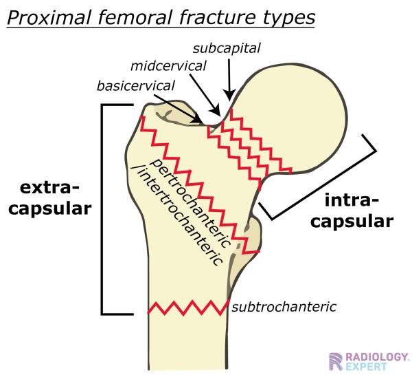 proximal femur fracture