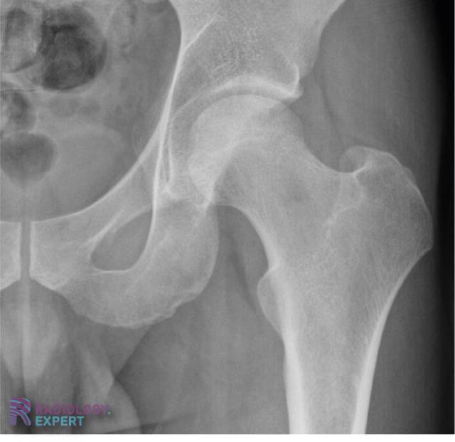 Normale anatomie X-heup (AP opname)