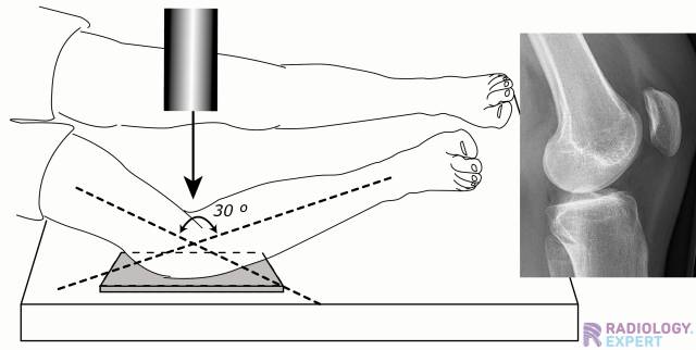 Radiographic Positioning Of The Knee