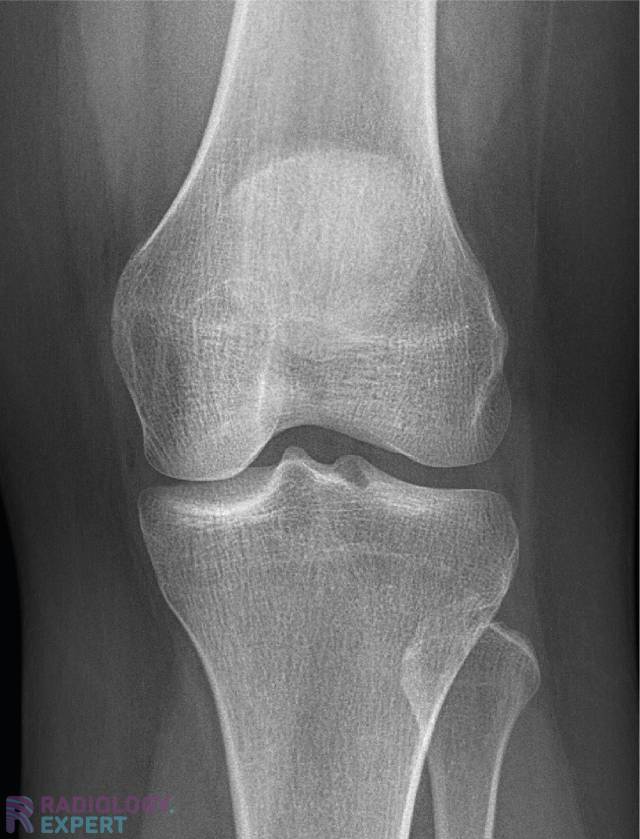 X Knee