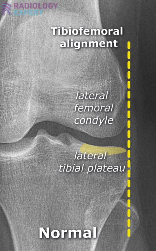 X Knee X Knee