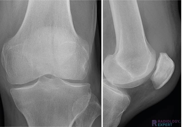 Fractured knee xray sale