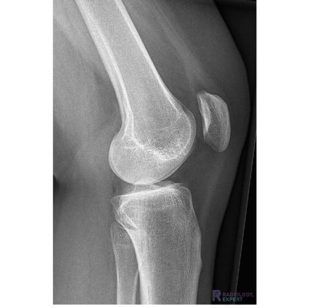 Normale anatomie X-knie 