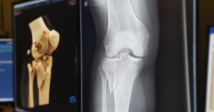 X-Knie