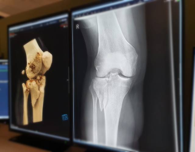 X-Knie