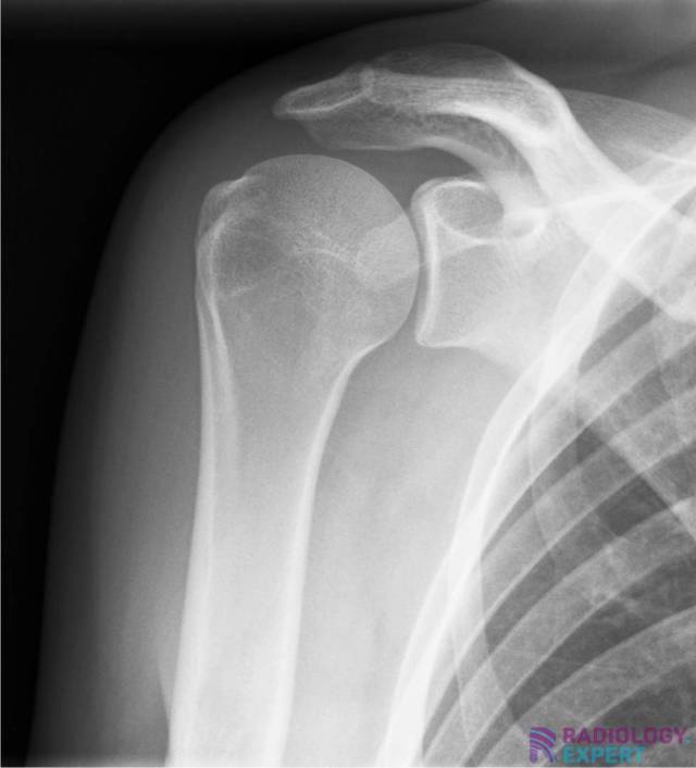 X-Shoulder